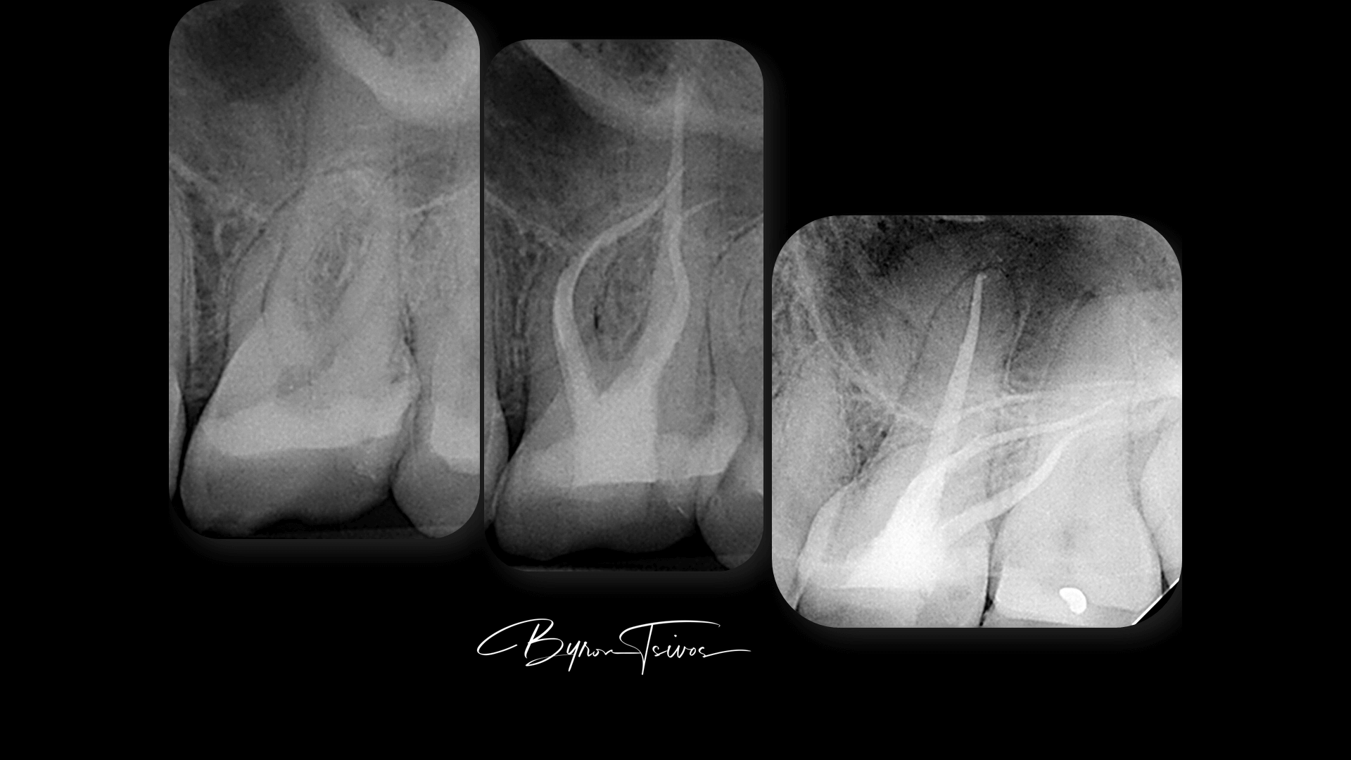 Broken Instrument Removal - Case 6
